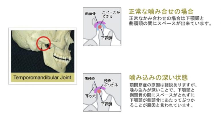 顎関節症の原因