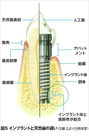 インプラントとは