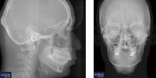 セファロメトリー撮影